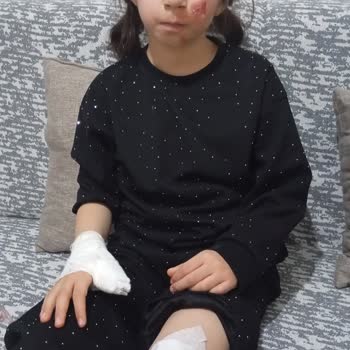 Beam Scooter Fren Arızası Ve Kontrolsüz Gaz Verme Nedeniyle Çocuğum Yaralandı