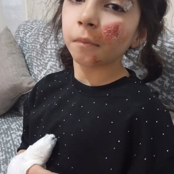 Beam Scooter Fren Arızası Ve Kontrolsüz Gaz Verme Nedeniyle Çocuğum Yaralandı