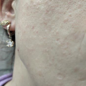 Vaseline Gluta Hya Sıkılaştırıcı Serumu Ciltte Alerjik Reaksiyon