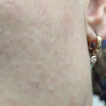 Vaseline Gluta Hya Sıkılaştırıcı Serumu Ciltte Alerjik Reaksiyon