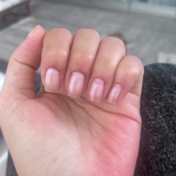 Hijyenik Olmayan Manikür Sonrası Tırnak Diplerinde Şiddetli İltihap