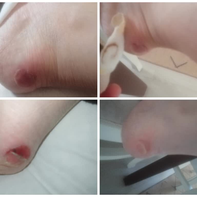 Nine West Ayakkabısının Kırılması Nedeniyle Ağır Ayak Yarası Ve Red Kararı