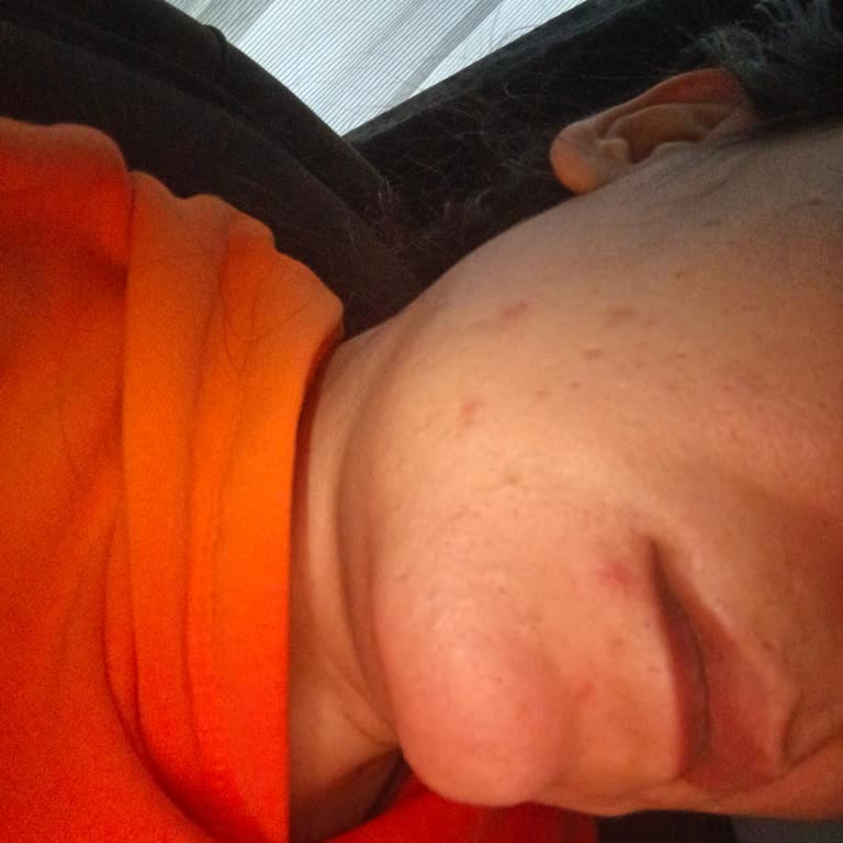 Dove Pembe Sabunu Alerjik Cilt Reaksiyonu Ve Süren Sivilce Şikayeti