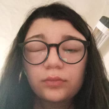 Saç Boyası Kullanımından Şiddetli Alerjik Reaksiyon Ve Hastane Yatışı