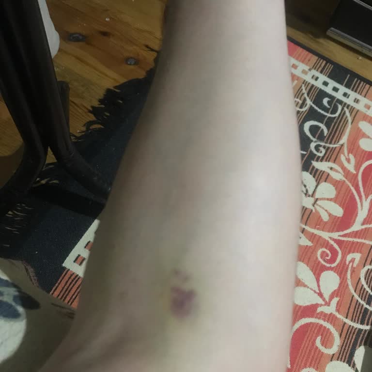 Kan Bağışı Sonrası Yaşadığım Şiddetli Sağlık Sorunları Ve Kan Nakli Talebi