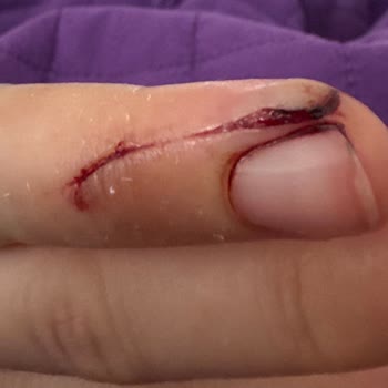 Karaca Çaydanlık Cam Kısmı Elimi Kesmesi