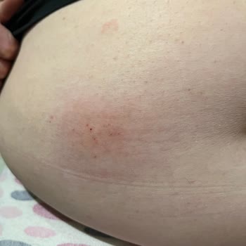 Mounjaro İğnesiyle Yaşadığım Şiddetli Alerjik Reaksiyon Ve İade Talebi