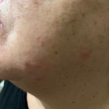 Mounjaro İğnesiyle Yaşadığım Şiddetli Alerjik Reaksiyon Ve İade Talebi