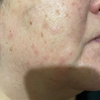 Mounjaro İğnesiyle Yaşadığım Şiddetli Alerjik Reaksiyon Ve İade Talebi