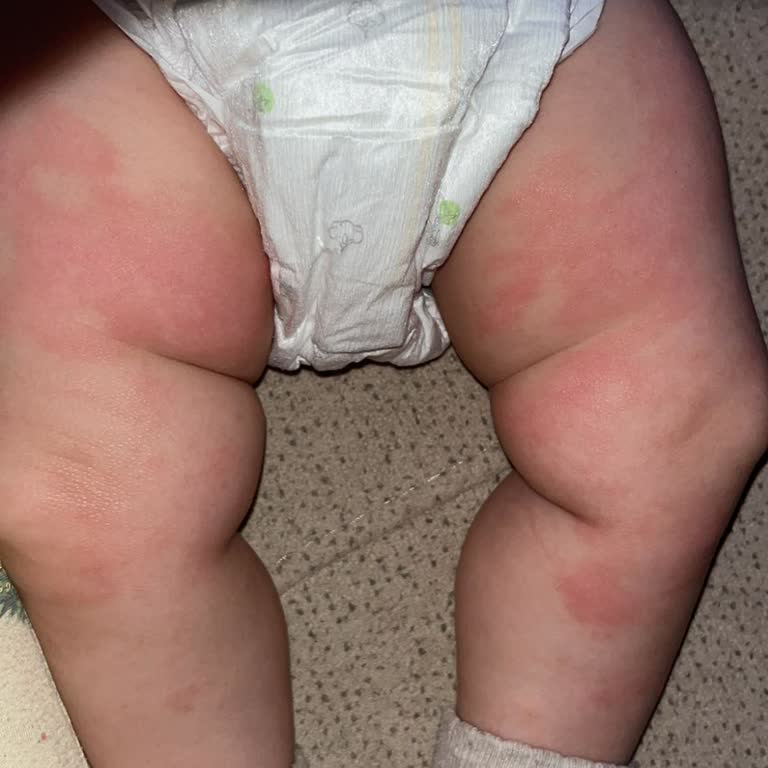 Bebek Alerjisi İhmal Edildi, Maflor İlacı Kızarıklığa Neden Oldu