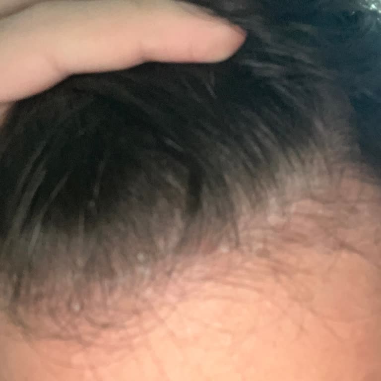 Urban Care Şampuanı Saç Derimde Şiddetli Kaşıntı, Egzama Ve Dökülmeye Yol Açtı