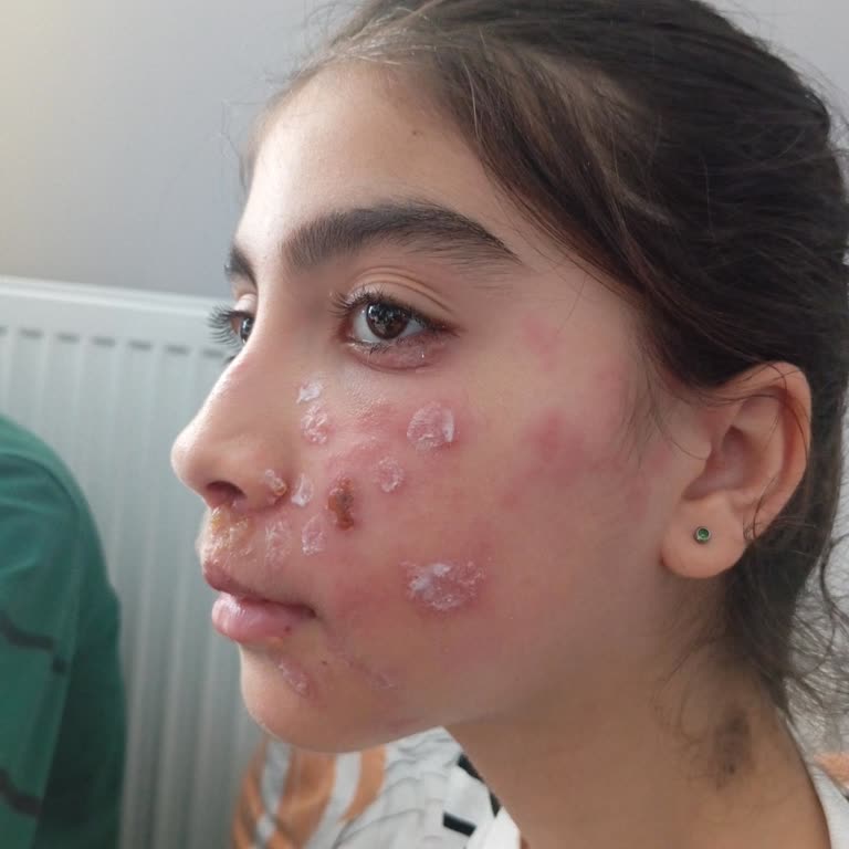 Stajyer Hatası: Yanlış İğne Uygulaması Sonrası Kızımda Kalıcı Şişlik Ve Yara