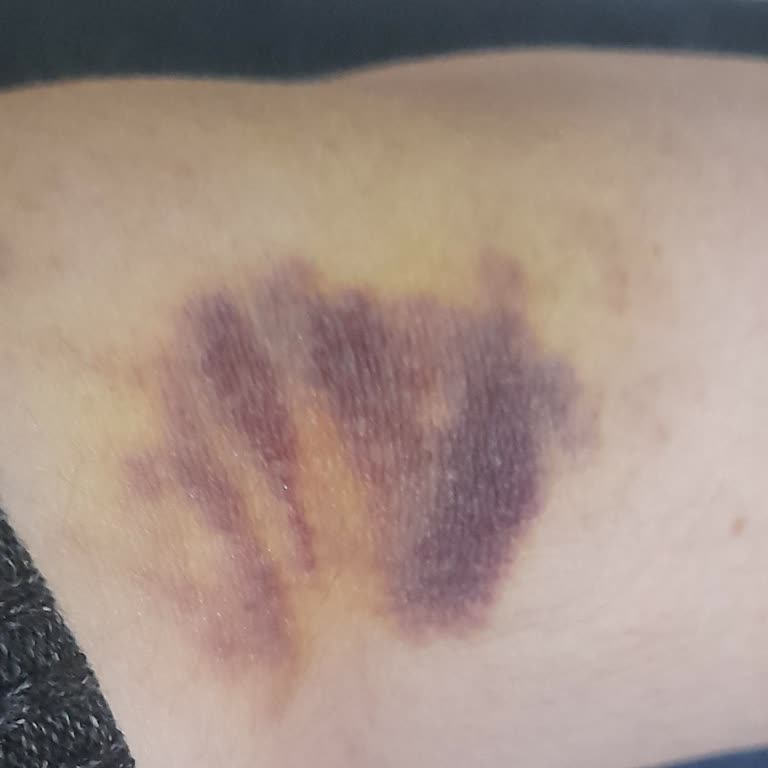 Kan Alımında Damar Zedelenmesi Ve Uzman Hemşire Talebi