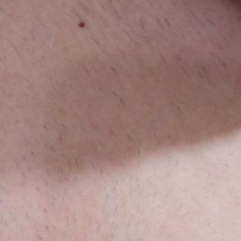 Cildime Zarar Veren Tıraş Makinesi Ve Rossmann’ın İade Reddi