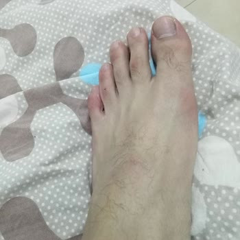 Lumberjack Ayakkabısının Kalıbı Hatalı Ve Ayağımda Şiddetli Yara Açtı, İade Ve Değişim Talebi