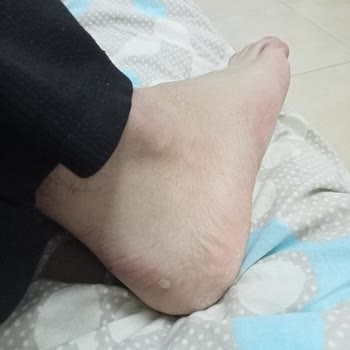 Lumberjack Ayakkabısının Kalıbı Hatalı Ve Ayağımda Şiddetli Yara Açtı, İade Ve Değişim Talebi