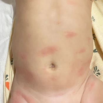 Hipp Organik Combiotic Kullanımında Bebekte Şiddetli Alerjik Reaksiyon Ve İade Talebi