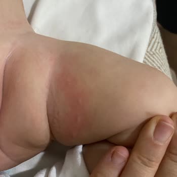 Hipp Organik Combiotic Kullanımında Bebekte Şiddetli Alerjik Reaksiyon Ve İade Talebi