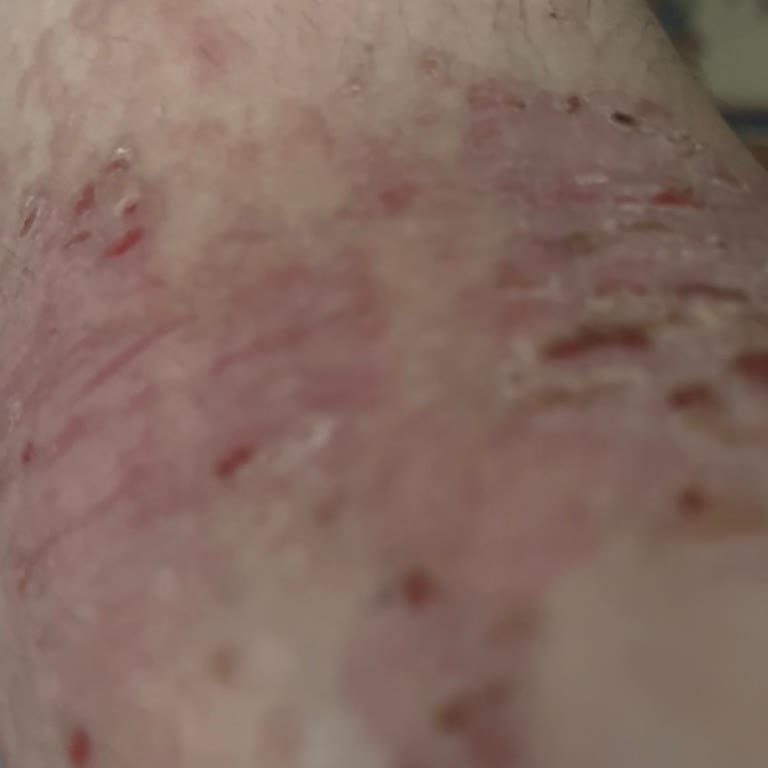 Gratis Ürünü Cildime Şiddetli Alerjik Reaksiyon Ve Kanser Şüphesi Getirdi