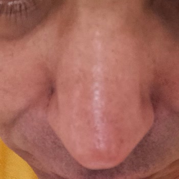 Op. Dr. Mehmet Taylan Güçlütürk Burun Estetiği Sonucu Memnuniyetsizliği Ve Ücret İadesi Talebi