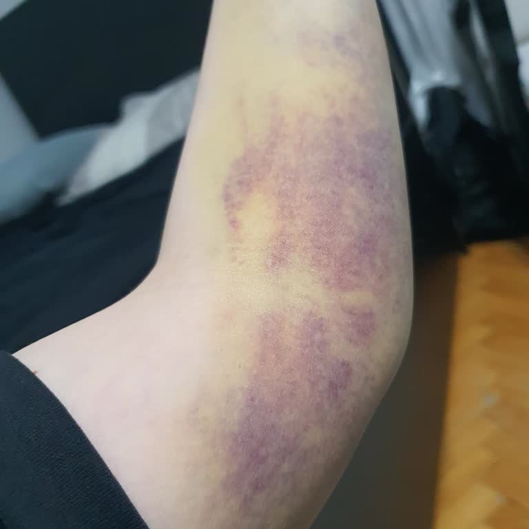 Kan Alma İşleminde Sol Kol İsteğine Saygısızlık Ve Damar Patlaması