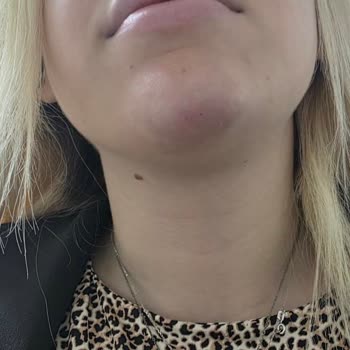 Dr. Alsuu Kızarıklık Ve İz Hâlâ Devam Ediyor Ve Çenem Üzerine Yatamıyorum