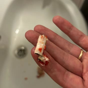 Antep Pazarı Lokumda Sigara İzmariti Bulunması, Aft Ve Yara Oluşması