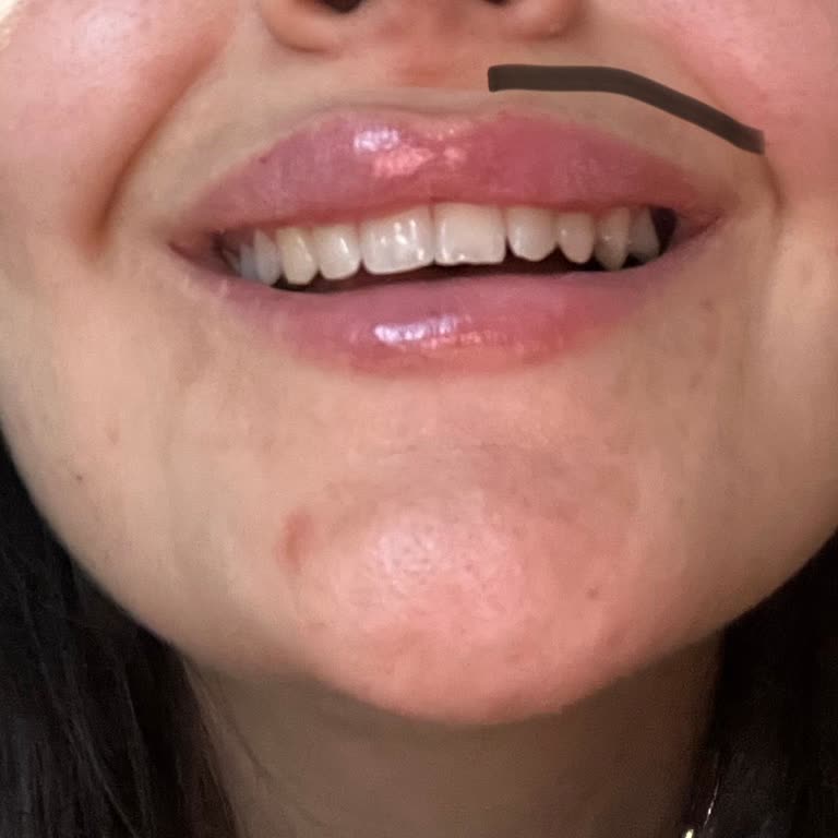 Meral Akça Güzellik Merkezi Asimetri Ve Hatalı Dudak Dolgusu