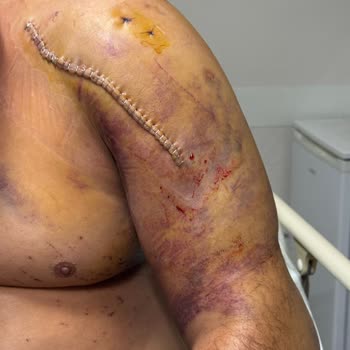 Marmaris Ahu Hetman Hastanesi Enfeksiyonlu Ameliyatı Sonrası Uzayan Tedavi, Maddi Ve Manevi Zararlar