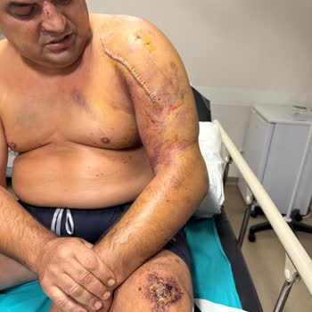 Marmaris Ahu Hetman Hastanesi Enfeksiyonlu Ameliyatı Sonrası Uzayan Tedavi, Maddi Ve Manevi Zararlar