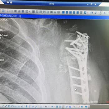Marmaris Ahu Hetman Hastanesi Enfeksiyonlu Ameliyatı Sonrası Uzayan Tedavi, Maddi Ve Manevi Zararlar
