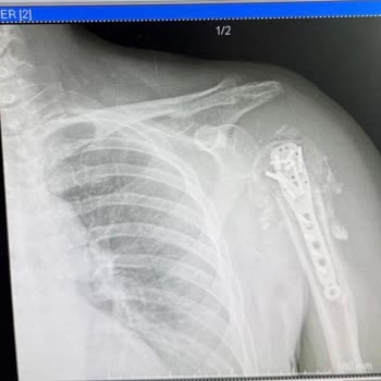 Marmaris Ahu Hetman Hastanesi Enfeksiyonlu Ameliyatı Sonrası Uzayan Tedavi, Maddi Ve Manevi Zararlar