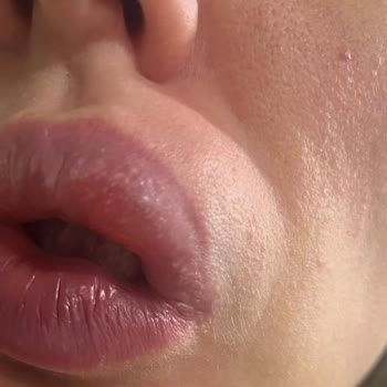 Avon Clinic'te Dudak Dolgusu Sonrası Şiddetli Sert Topak Ve Güven Kaybı