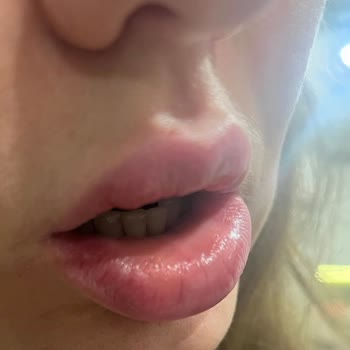 Avon Clinic'te Dudak Dolgusu Sonrası Şiddetli Sert Topak Ve Güven Kaybı