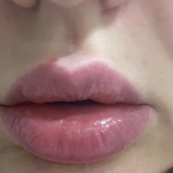 Avon Clinic'te Dudak Dolgusu Sonrası Şiddetli Sert Topak Ve Güven Kaybı