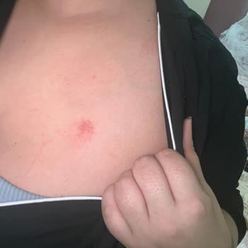 Watsons Göğüs Şekillendirme Bandı Hassas Ciltte Alerji Ve Yaralar Oluşturdu