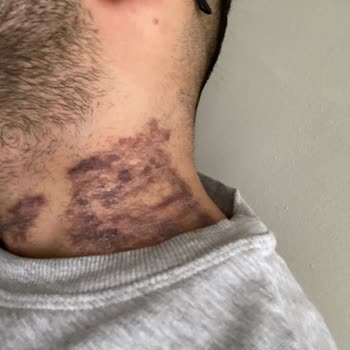 Dövme Silme İşlemi Sonrası Yanık Ve İz Şikayeti: 28.000 TL İadesi Talebi