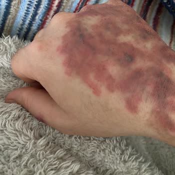 Dövme Silme İşlemi Sonrası Yanık Ve İz Şikayeti: 28.000 TL İadesi Talebi