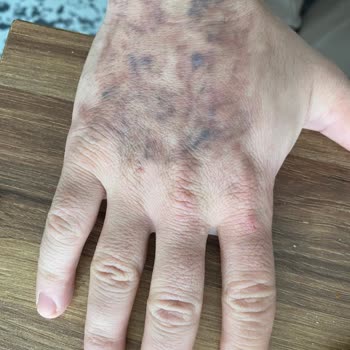 Dövme Silme İşlemi Sonrası Yanık Ve İz Şikayeti: 28.000 TL İadesi Talebi