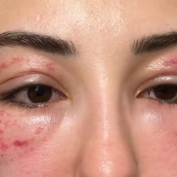 Yüzde Şiddetli Ağrı Ve Uzun Süreli Morluklar Nedeniyle Medova Hastanesi’nden Tazminat Talebi