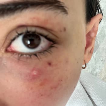 Yüzde Şiddetli Ağrı Ve Uzun Süreli Morluklar Nedeniyle Medova Hastanesi’nden Tazminat Talebi