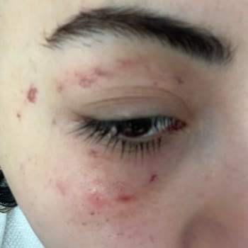 Yüzde Şiddetli Ağrı Ve Uzun Süreli Morluklar Nedeniyle Medova Hastanesi’nden Tazminat Talebi