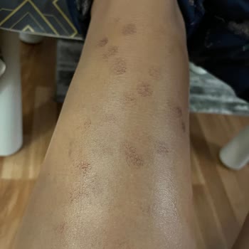 Nets Polikliniği Yanık Oluştu!