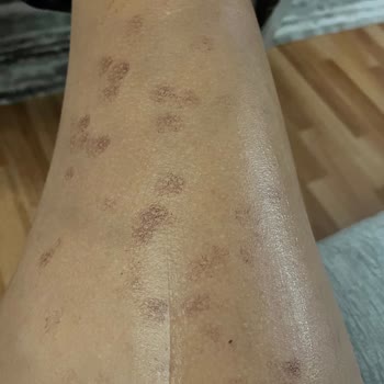 Nets Polikliniği Yanık Oluştu!