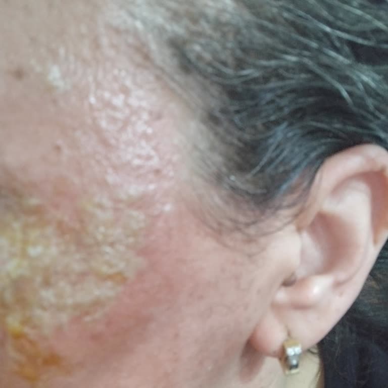 Yüz Peelingi Sonrası Enfeksiyon Ve Şirketin Destek Vermemesi