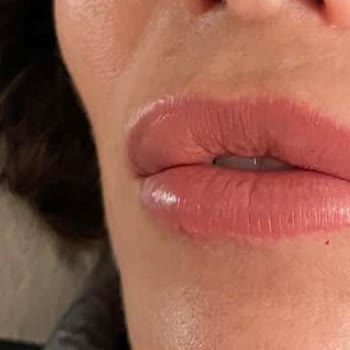 Dolgu İşlemi İki Kez Bozuldu Ve Yetkisiz Bıyık Doldurmasıyla Psikolojik Ve Maddi Mağduriyet