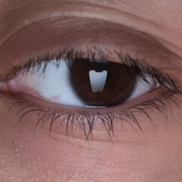 Kirpik Uygulamasındaki Hatalar Ve Uzman Değişikliği Nedeniyle Güven Kaybı