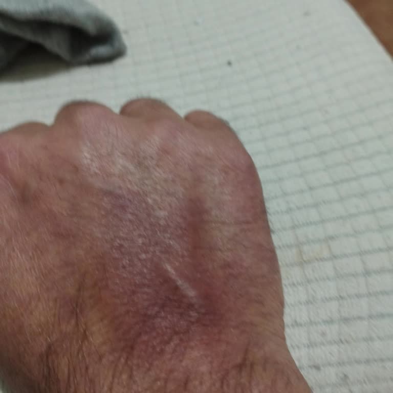 Acil Serviste Damar Yolu Açma Denemeleri Sonrası Sağ Kolda Morarma Ve Şüpheli Kanama