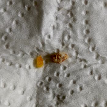 Kemik Parçalarıyla Dişine Zarar Veren Uzman Kasap Köfte Ürününde Güvenlik Krizi