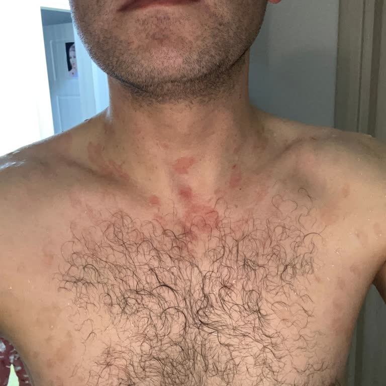 Duru Nem Bombası Şampuanı Alerjik Reaksiyon Ve Tedavi Masrafları İçin Tazminat Talebi